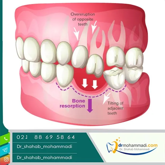 اگر ایمپلنت نکنیم چه میشود؟